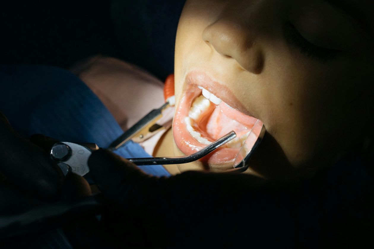 Custom Mouthguards vs. Over-the-Counter Options.jpg