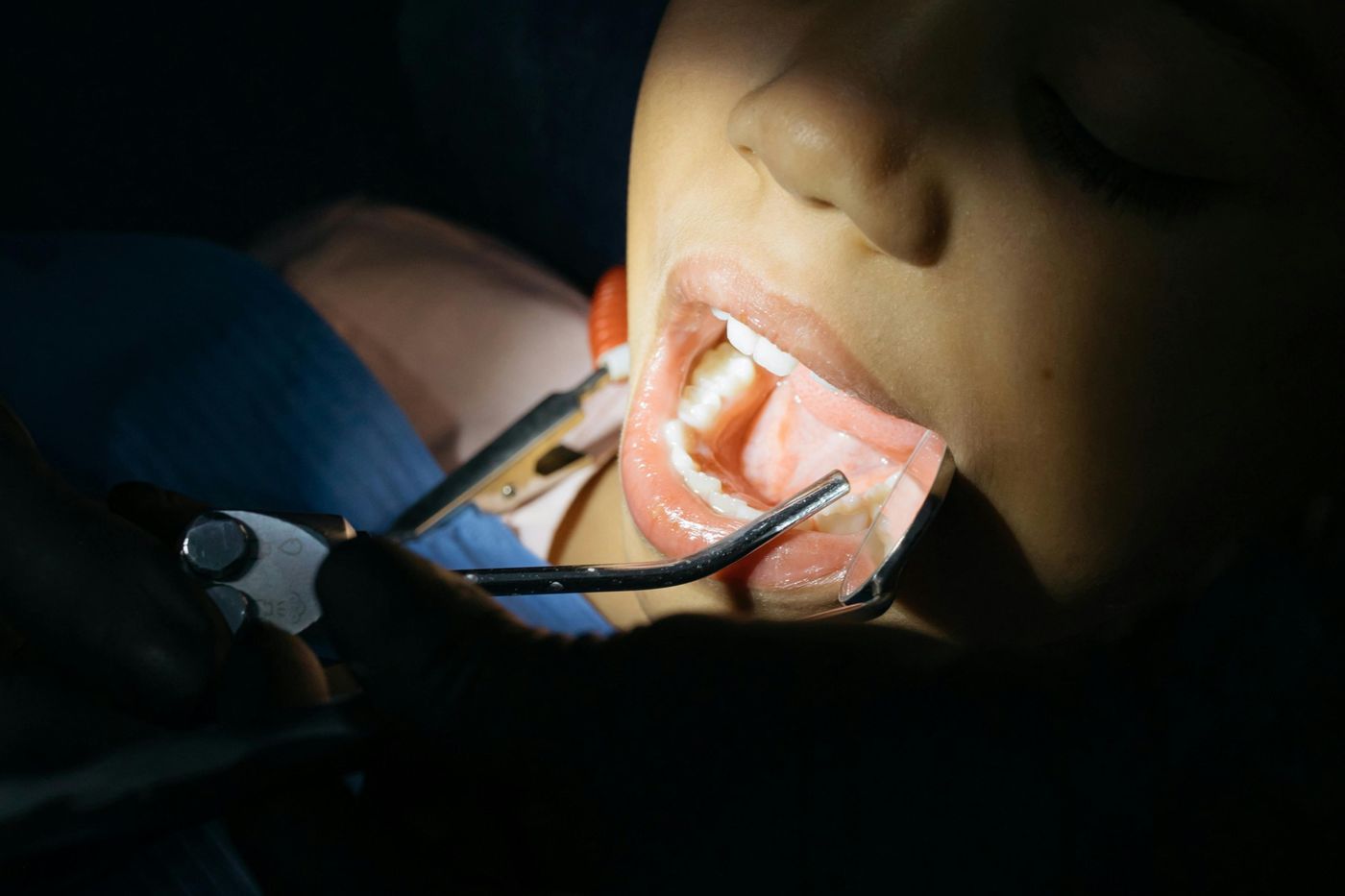 Custom Mouthguards vs. Over-the-Counter Options.jpg