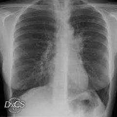 Chest X-Ray  - Diagnostic X-Ray Consultation Services